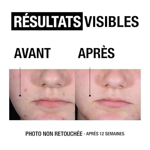 Neutrogena – Gel Nettoyant Anti-Boutons + Acide Salicylique + 2% PHA (200 ml) – Soin visage anti-boutons non comédogène et non gras – Nettoyant visage pour peaux à tendance acnéique sans parfum - Image 4