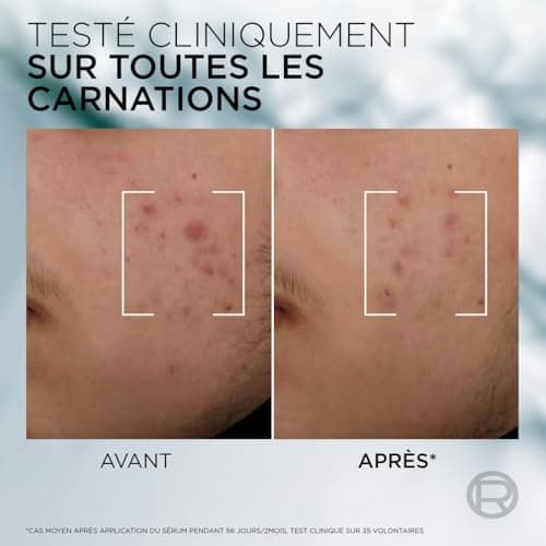 L'Oréal Men Expert - Sérum Anti-Imperfections - Élimine les Imperfections et Marques Post-Acné - Enrichi en Niacinamide et Acide Salicylique - Derma Control - 30 ml - Image 6